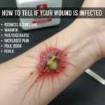 How to Tell If Your Wound Is Infected
